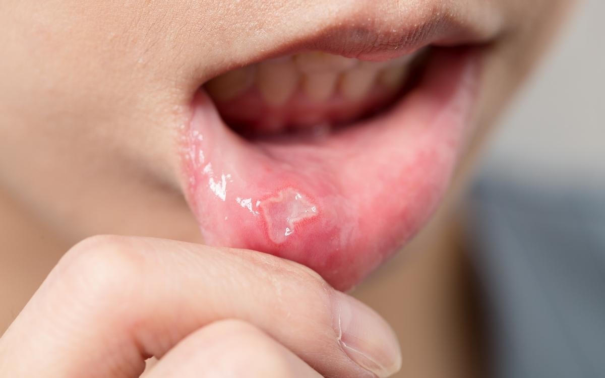 Afte della bocca: quali sono i rimedi principali