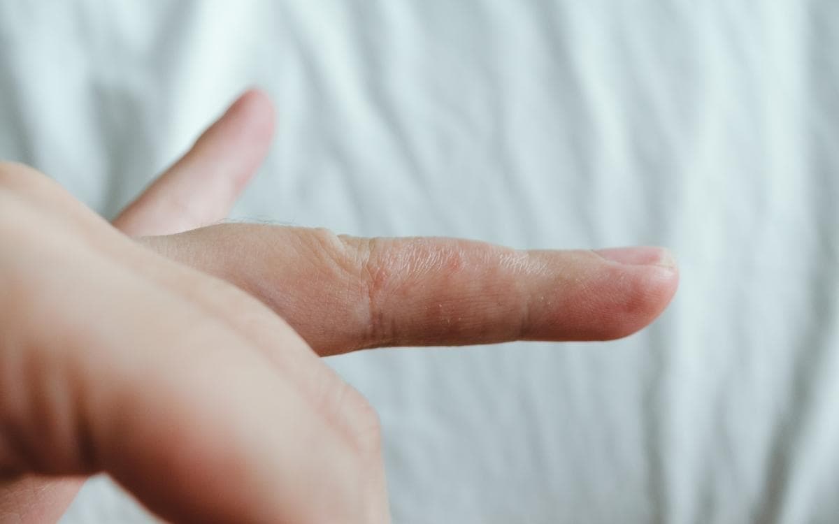 La disidrosi, malattia infiammatoria della pelle: conosciamola da vicino