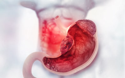 Sconfiggere l'Acidità di Stomaco: 10 Rimedi Efficaci per Ritrovare Benessere