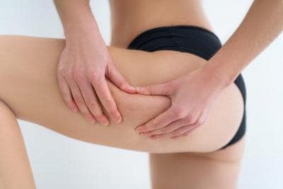SOS cellulite: come trattarla al meglio con Somatoline